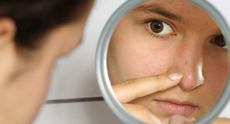 Cara Menghilangkan Jerawat di Area Hidung